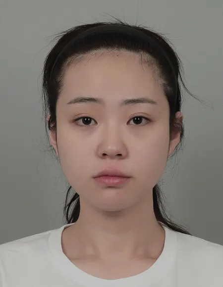 id Hospital - id B&A - Face Contouring,Eye Before