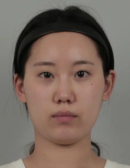 id Hospital - id B&A - Face Contouring,Nose,Eye Before