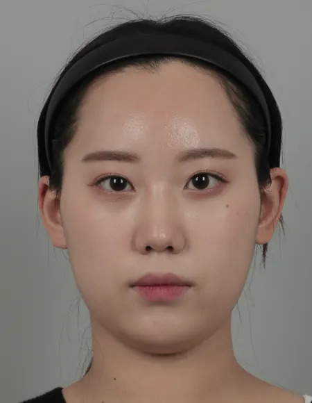 id Hospital - id B&A - Face Contouring,Nose,Eye After