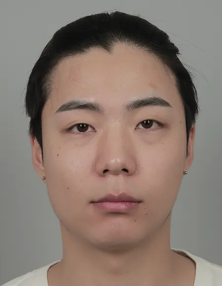 id Hospital - id B&A - Face Contouring,Eye,Nose Before