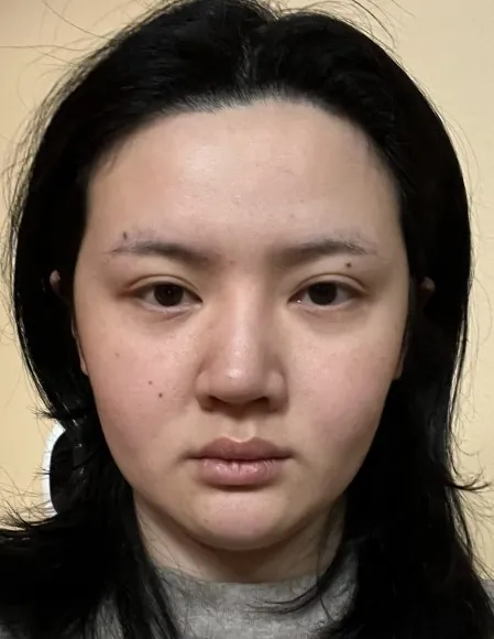id Hospital - id B&A - [Face Contouring+Nose] Jaw, Chin & Cheekbone Contouring & Rhinoplasty After