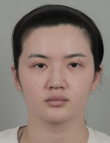 id Hospital - id B&A - [Face Contouring+Nose] Jaw, Chin & Cheekbone Contouring & Rhinoplasty Before