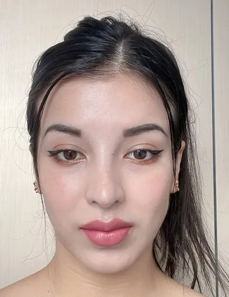 id Hospital - id B&A - [Nose] Nose Surgery & Rhinoplasty After