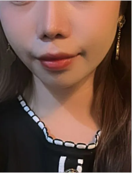 id Hospital - id B&A - [Nose]PrimaryNoseSurgery+Rhinoplasty After