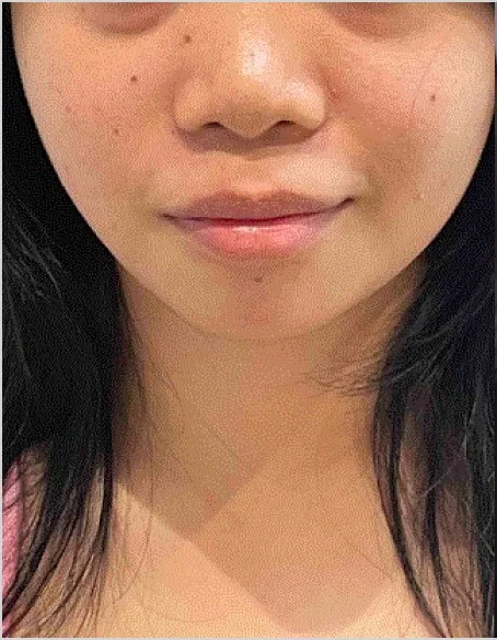 id Hospital - id B&A - [Nose]PrimaryNoseSurgery+Rhinoplasty Before