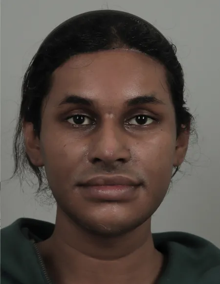id Hospital - id B&A - [FaceContouring+Anti-aging+Nose]FaceContouring+Facelift+Rhinoplasty After