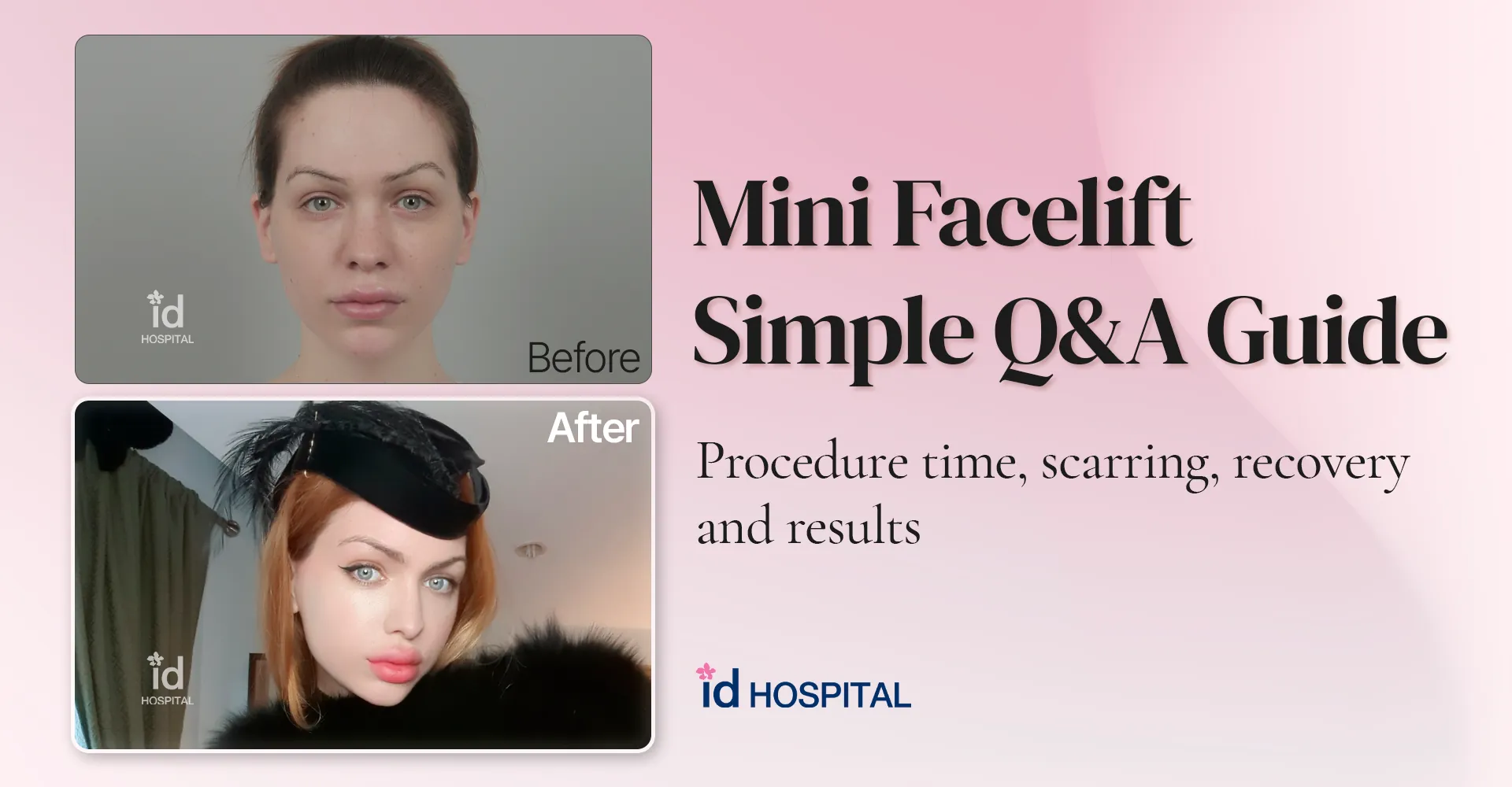 id Hospital - id blog - What Exactly Is a Mini Facelift? A Simple Guide with Q&A for Beginners