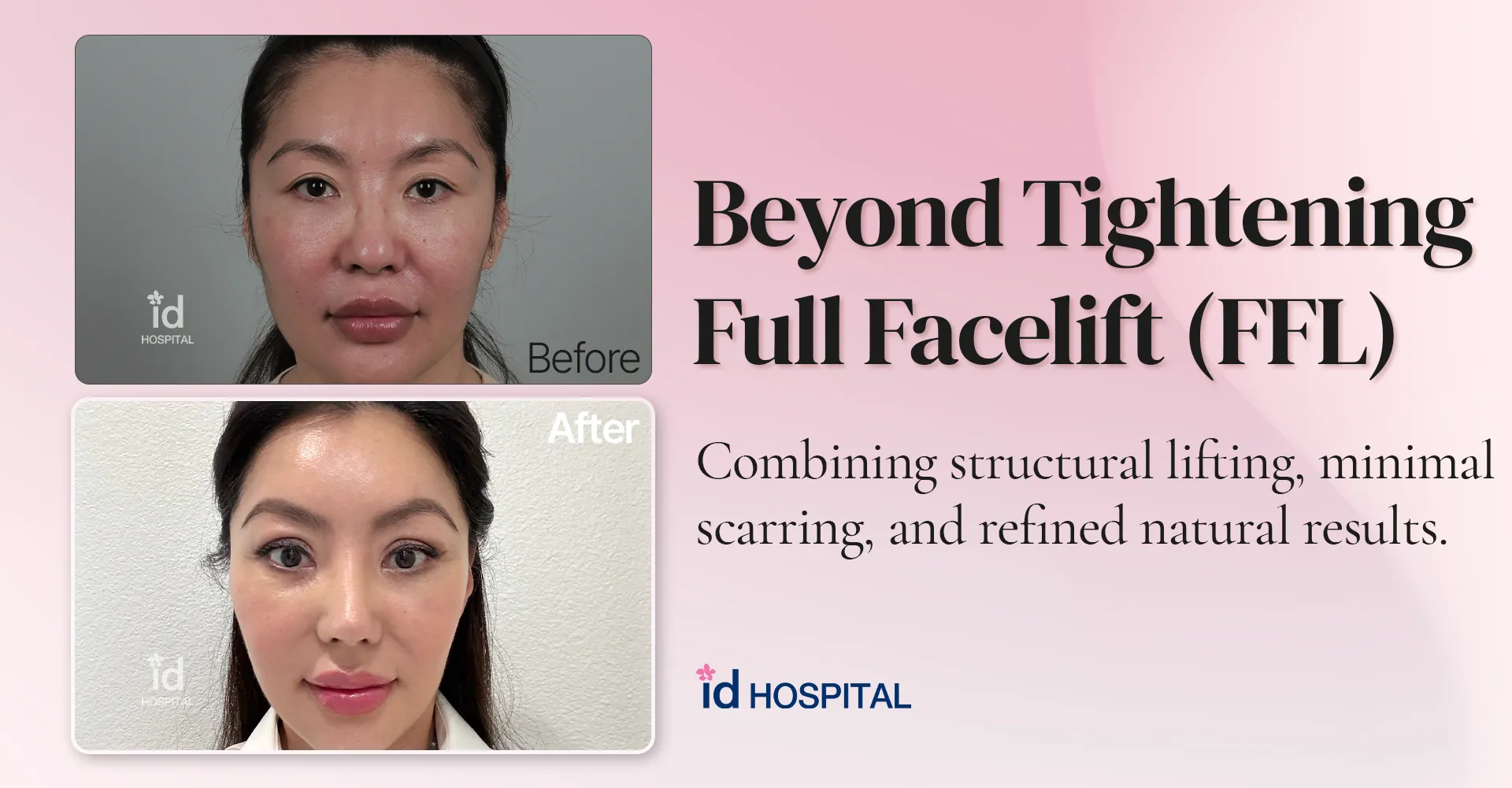 id Hospital - id blog - Beyond Skin Tightening: Full Facelift at id Hospital