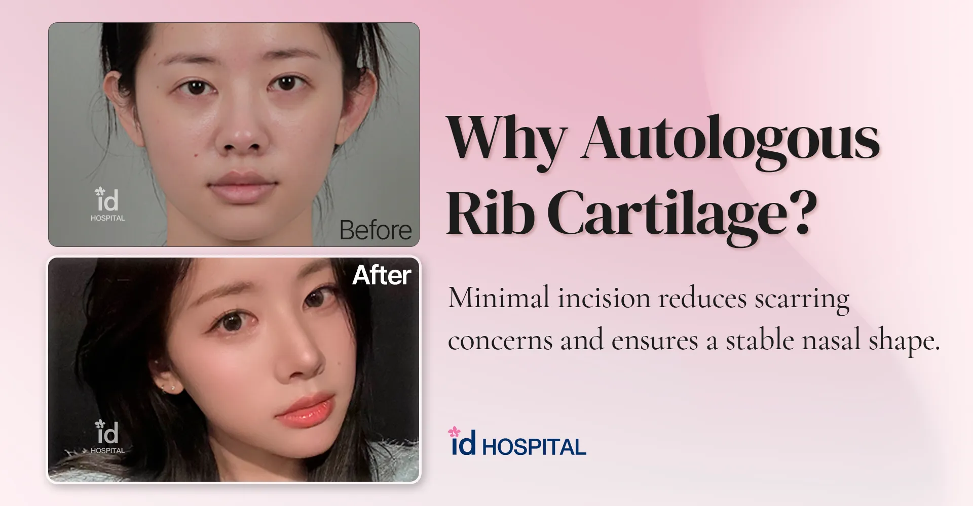 id Hospital - id blog - Autologous Rib Cartilage Rhinoplasty: The Final Stop for Nose Revision | id Hospital