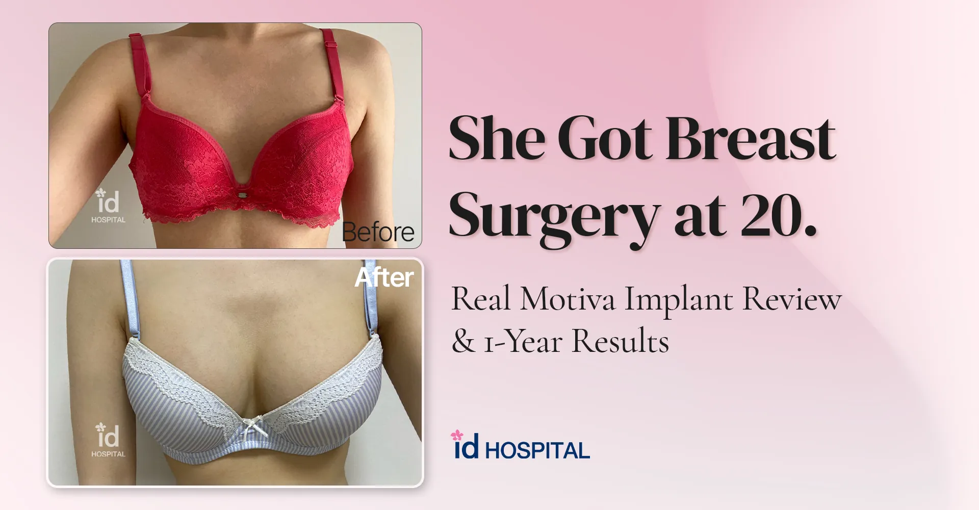 id Hospital - id blog - She Got Breast Surgery at 20: Real Motiva Implant Review & 1-Year Results