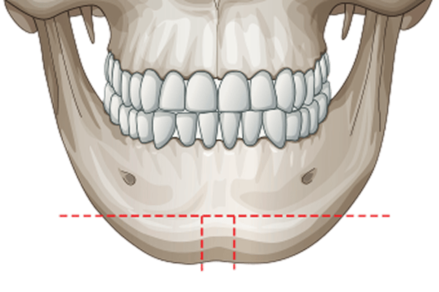 id Hospital - Thesis, research activities - T-Osteotomy