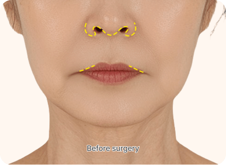 id Hospital - Anti-Aging Plus - Hybrid Lip Lift