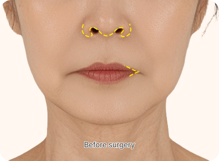 id Hospital - Anti-Aging Plus - Lip & Lip Corner Double Lift