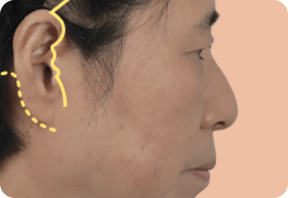id Hospital - Full Facelift - Full Facelift Step 1