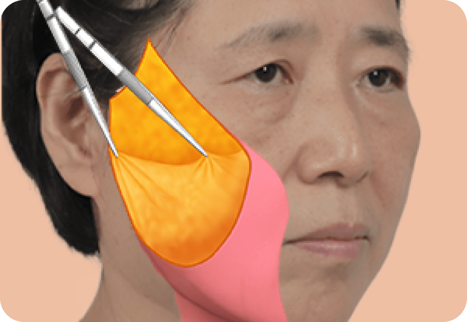 id Hospital - Full Facelift - Full Facelift Step 2