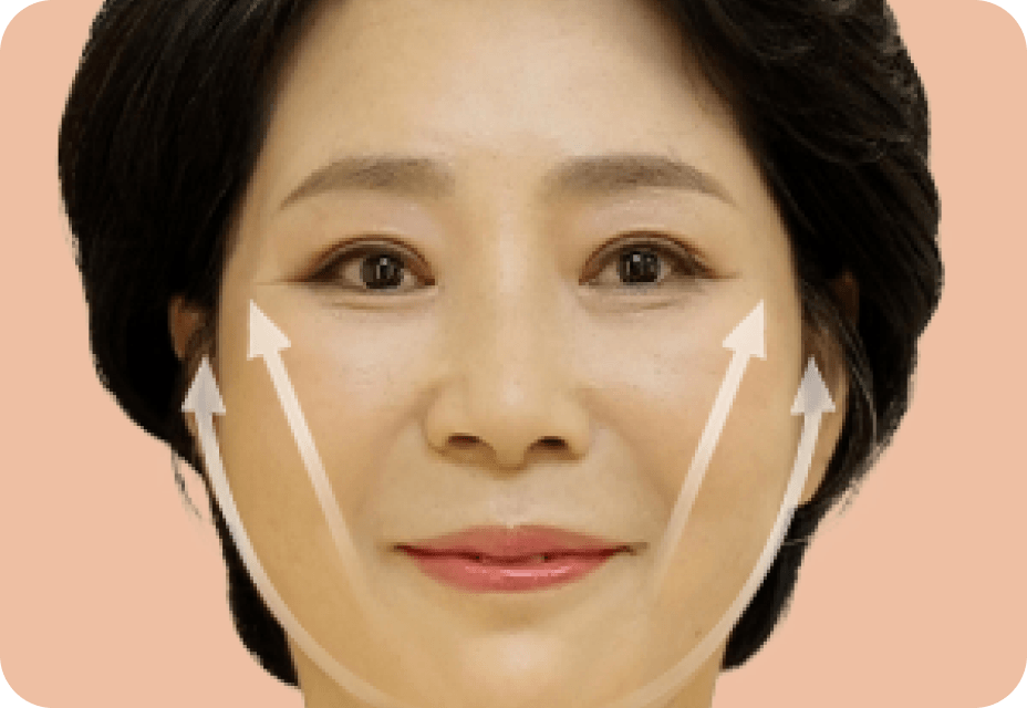 id Hospital - Full Facelift - Full Facelift Step 3