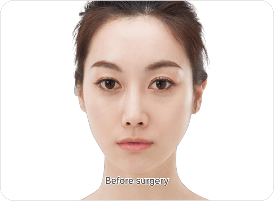 id Hospital - Fat Graft - Nano Fat Graft Before