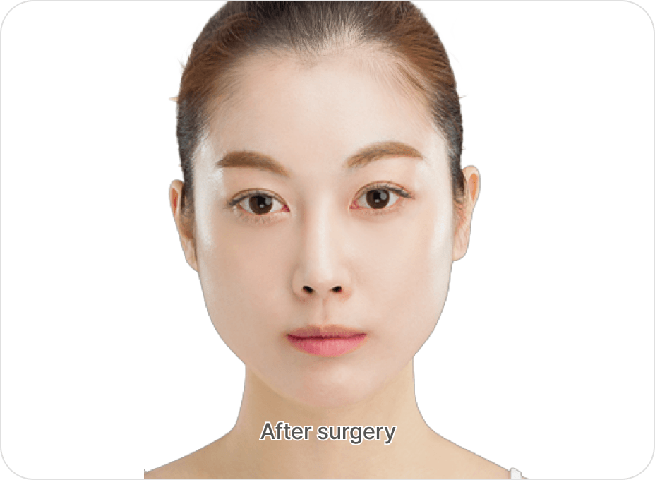 id Hospital - Fat Graft - Nano Fat Graft After
