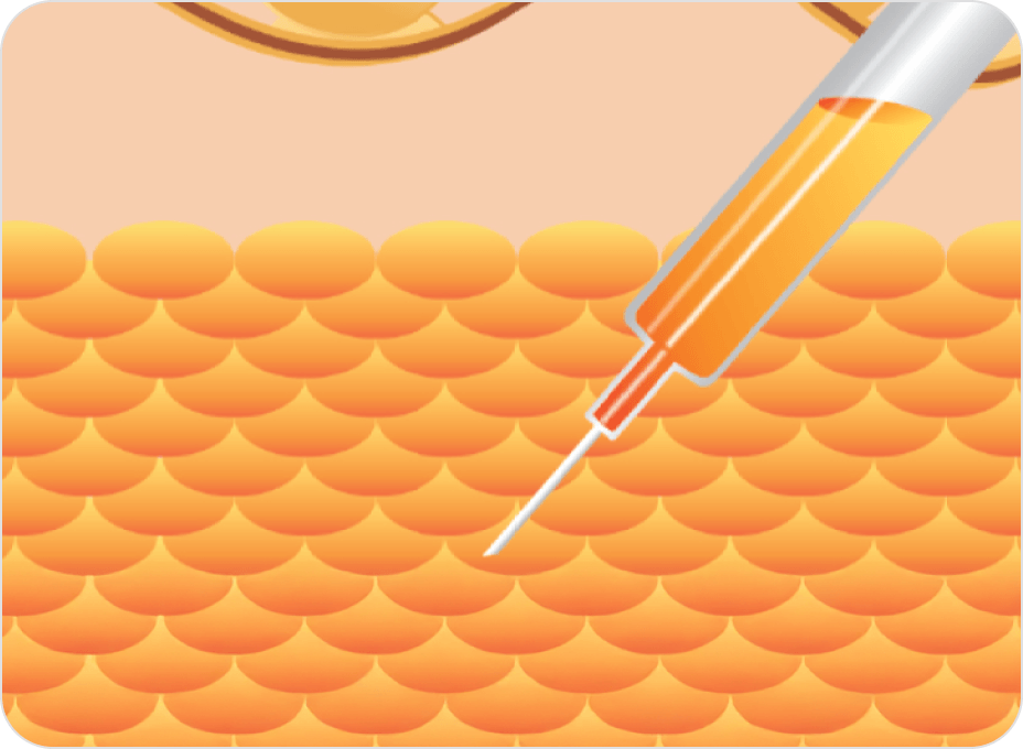 id Hospital - Fat Graft - Fat Extraction 2