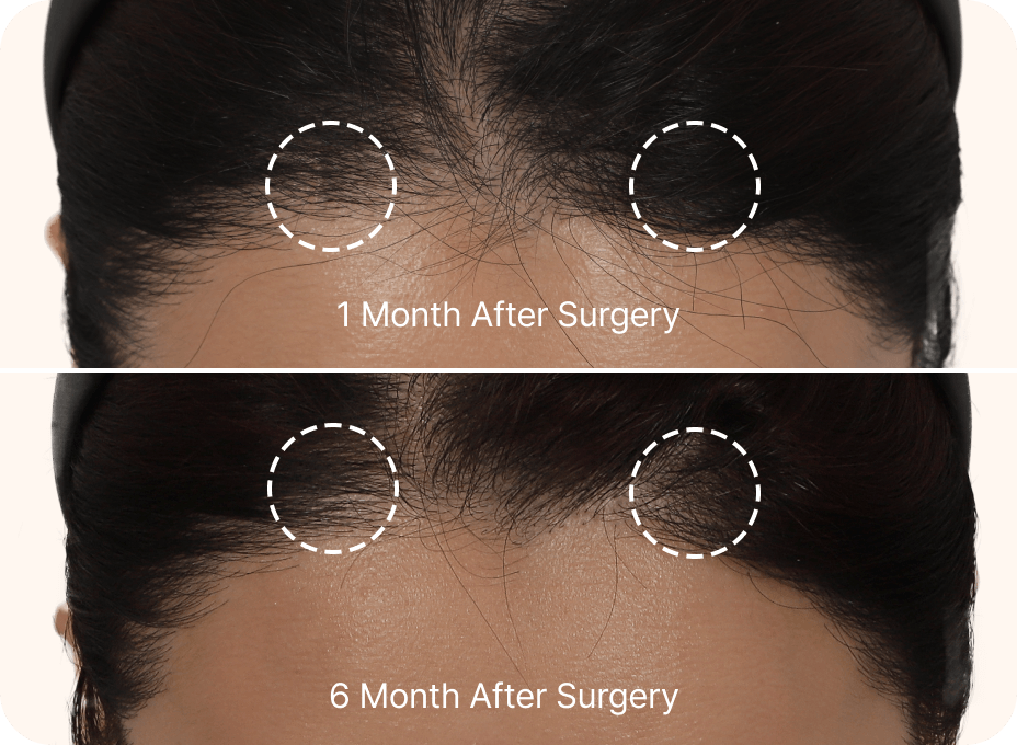 id Hospital - Mini Forehead Mini Double Chin Lift - Mini Forehead Lift No Scar