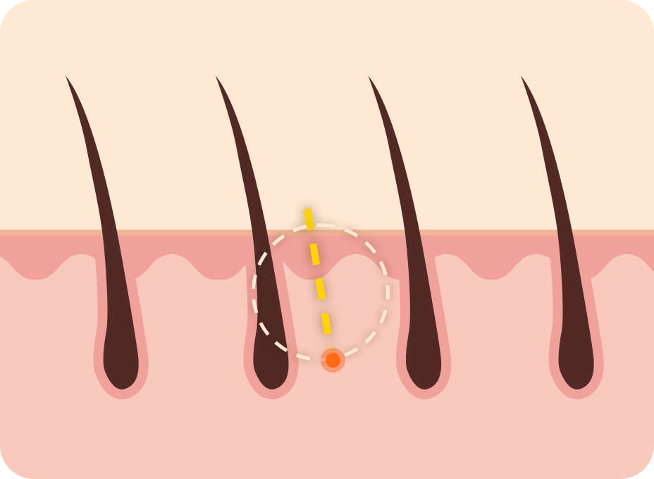 id Hospital - Mini Forehead Mini Double Chin Lift - Mini Forehead Lift No Hair Loss