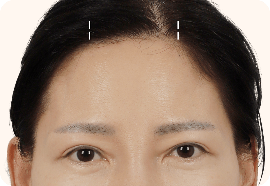 id Hospital - Mini Forehead Mini Double Chin Lift - Mini Forehead Lift Step 1