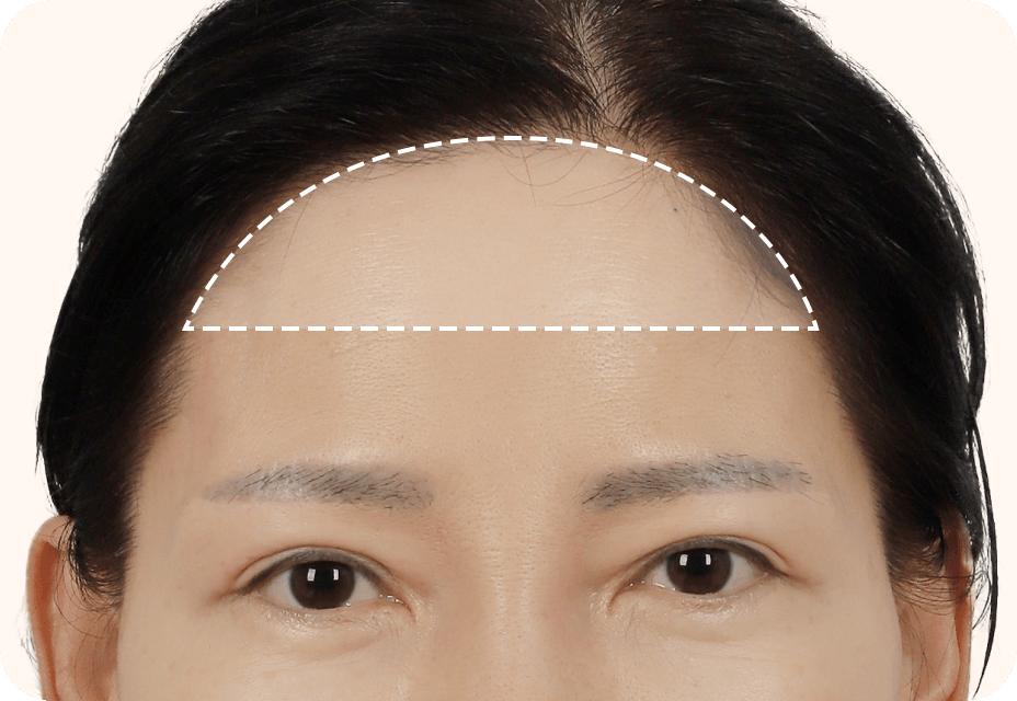 id Hospital - Mini Forehead Mini Double Chin Lift - Mini Forehead Lift Step 2