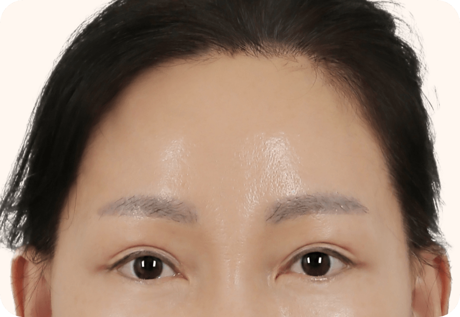 id Hospital - Mini Forehead Mini Double Chin Lift - Mini Forehead Lift Step 3
