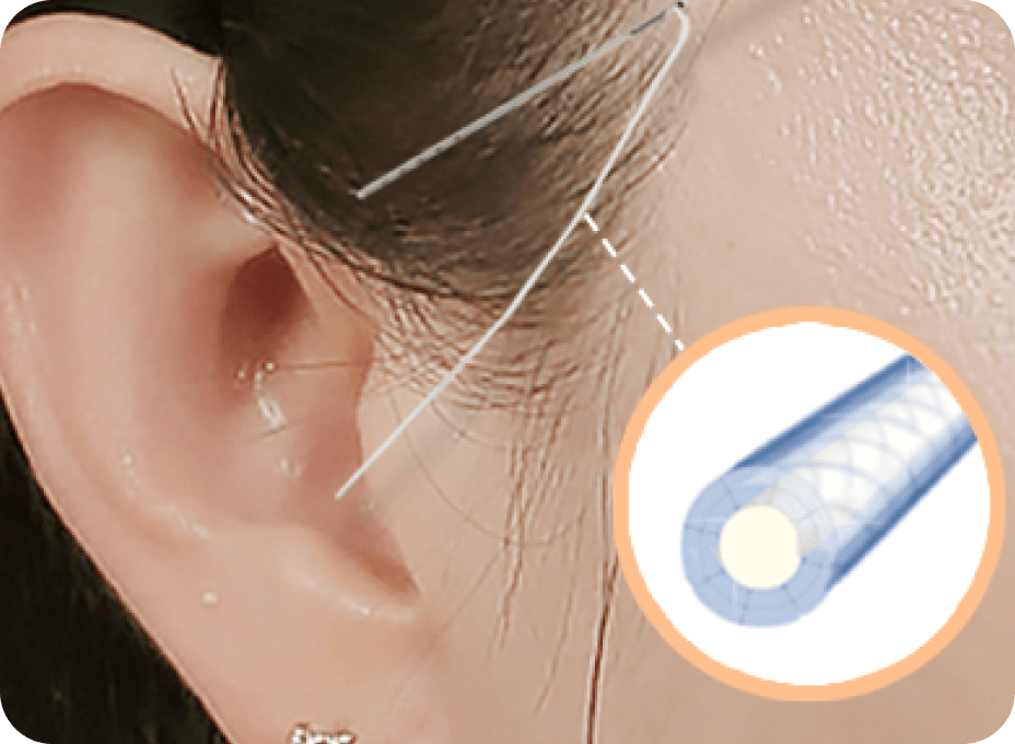 id Hospital - Full Facelift - SMAS Lift with Premium Elastic Band