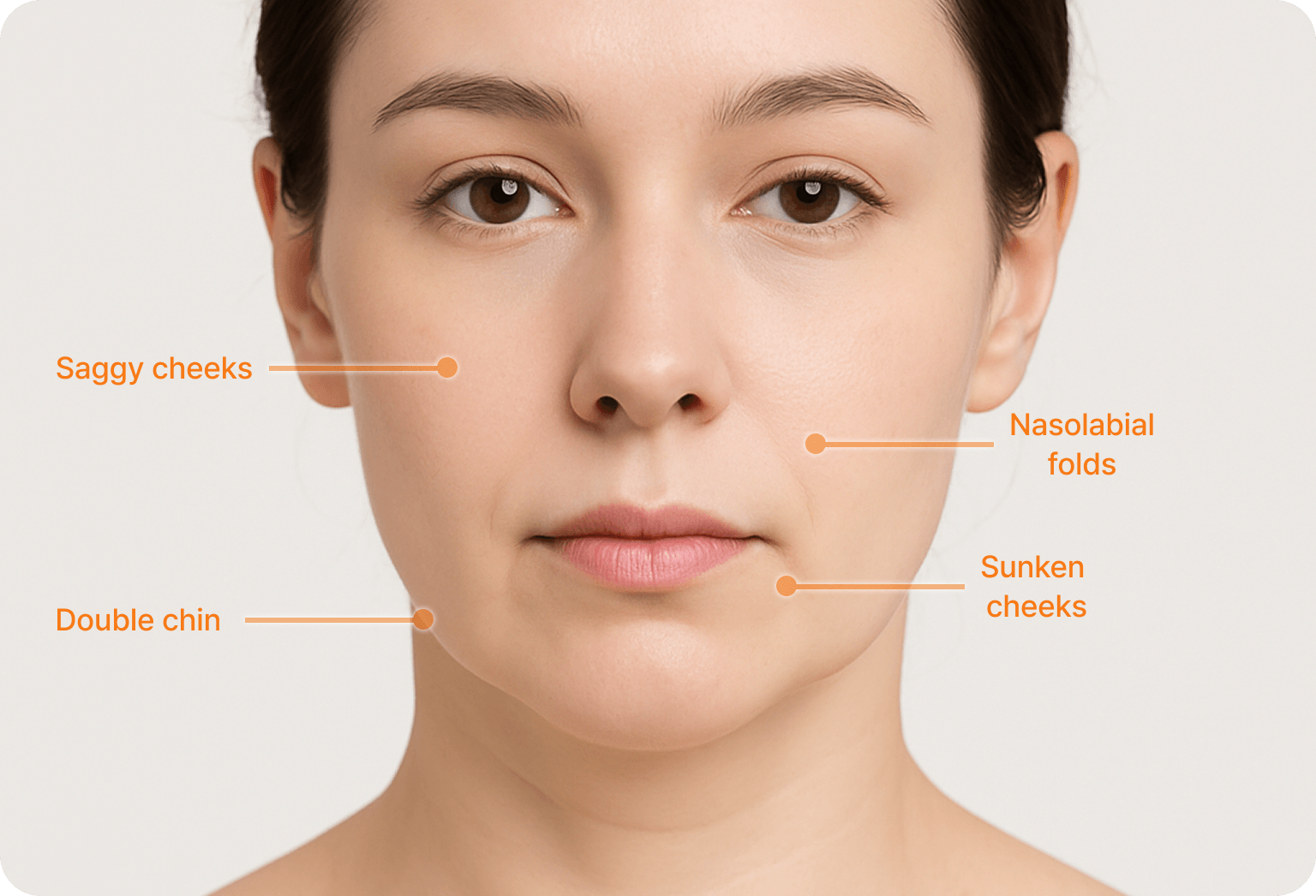 id Hospital - Minimal-incision SMAS Lift - Treatment Areas Diagram