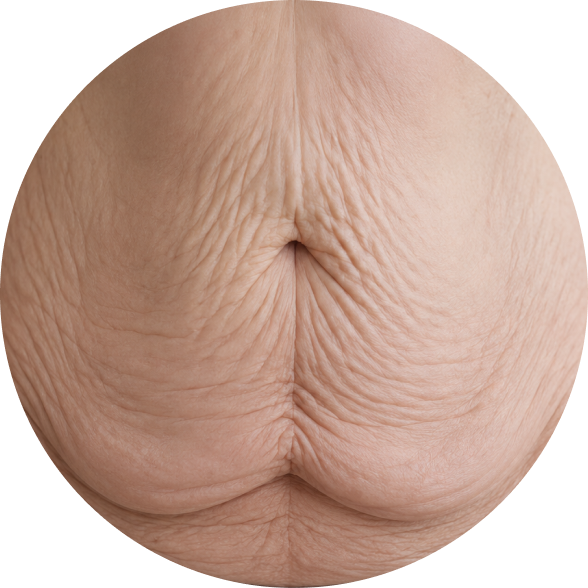 id Hospital - Tummy Tuck - Candidate 02