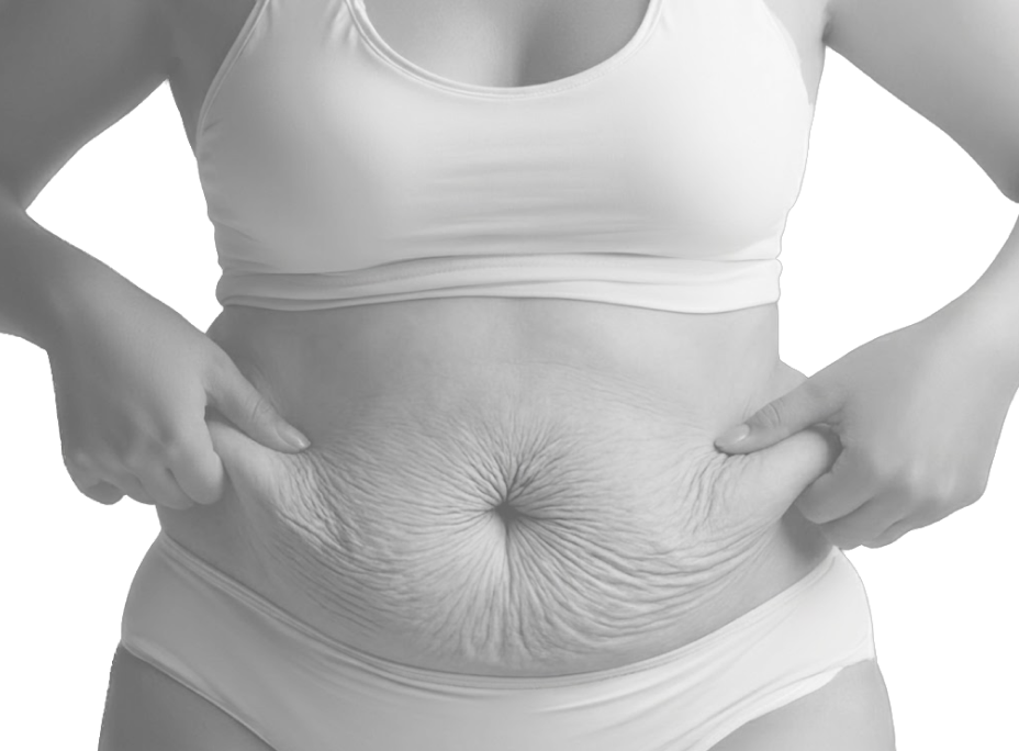 id Hospital - Tummy Tuck - Before