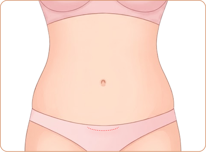 id Hospital - Tummy Tuck - Minimal incision (hidden in bikini line)