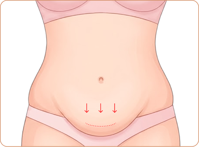 id Hospital - Tummy Tuck - Skin removal (belly button preserved)