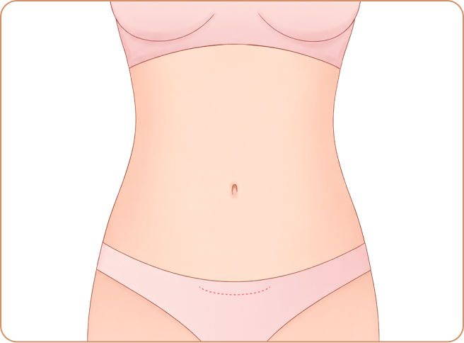 id Hospital - Tummy Tuck - Precision closure