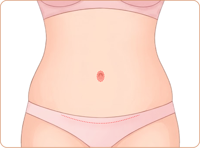 id Hospital - Tummy Tuck - Round incision (hidden in bikini line)