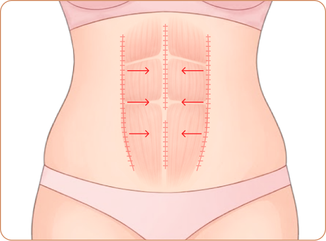 id Hospital - Tummy Tuck - Full muscle repair