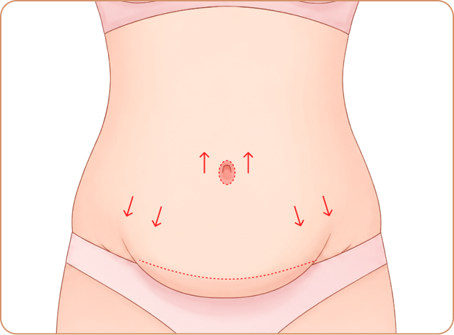id Hospital - Tummy Tuck - Extensive skin removal + belly button repositioning