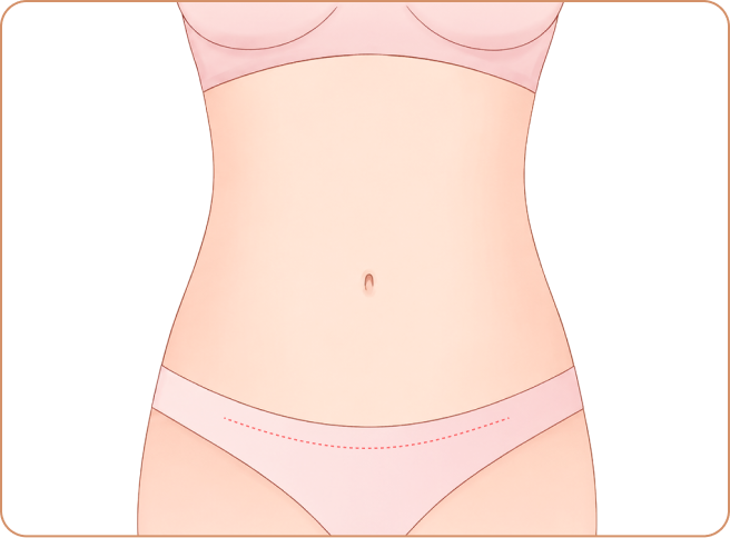 id Hospital - Tummy Tuck - Precision closure