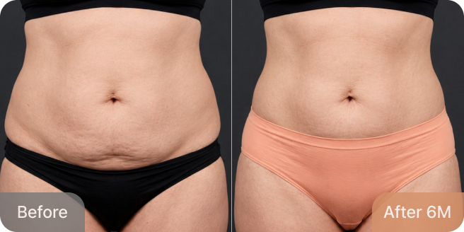 id Hospital - Tummy Tuck - Real Results