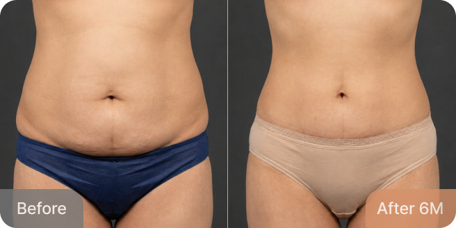 id Hospital - Tummy Tuck - Real Results