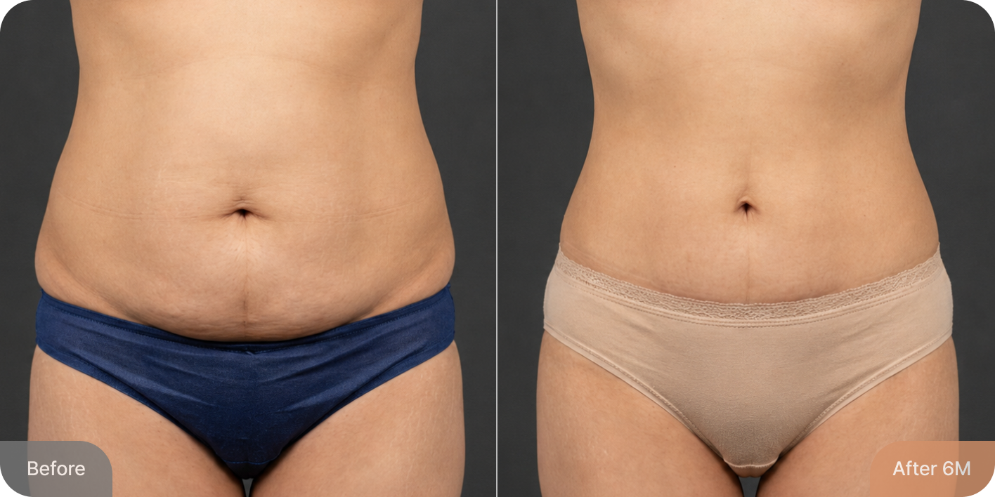 id Hospital - Tummy Tuck - Real Results