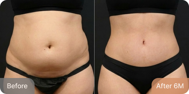 id Hospital - Tummy Tuck - Real Results