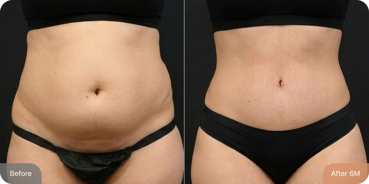 id Hospital - Tummy Tuck - Real Results