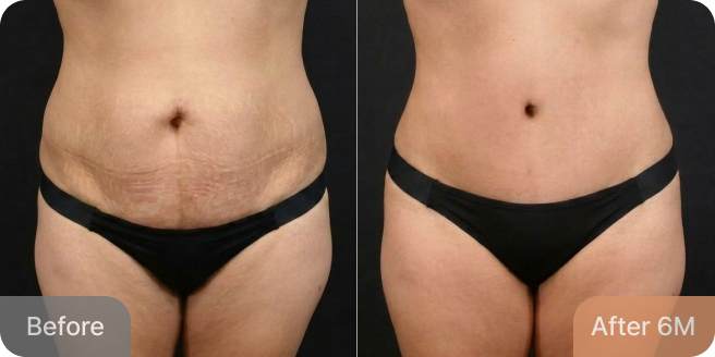 id Hospital - Tummy Tuck - Real Results