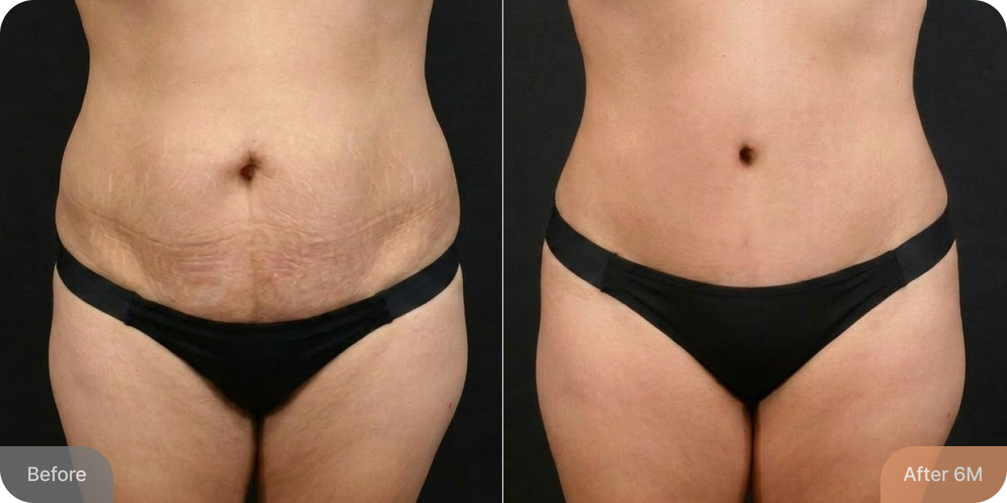 id Hospital - Tummy Tuck - Real Results