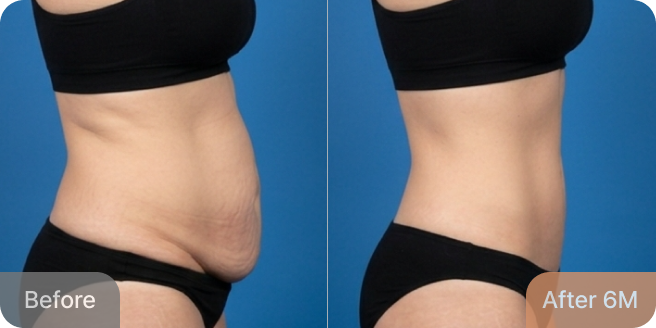 id Hospital - Tummy Tuck - Real Results