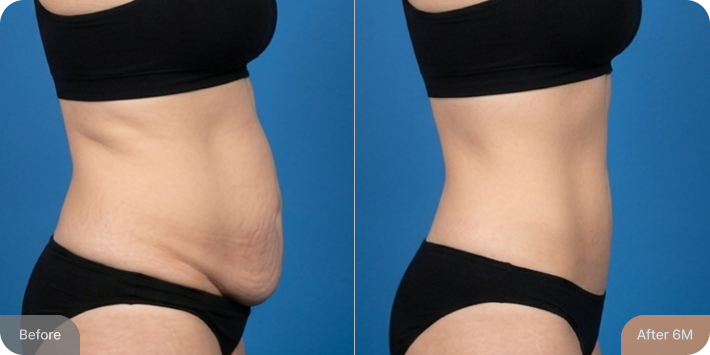id Hospital - Tummy Tuck - Real Results