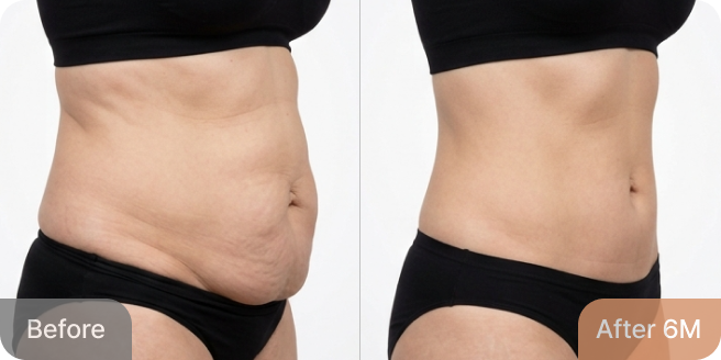 id Hospital - Tummy Tuck - Real Results