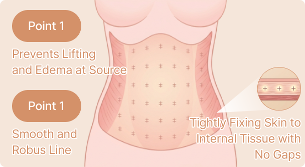 id Hospital - Tummy Tuck - Seamless Adhesion